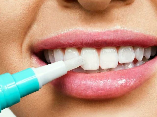 Отбеливание зубов в домашних условиях – это реально