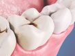 Причины возникновения появления кариеса зубов