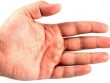 Сухая мозоль на руке: лечение и профилактика