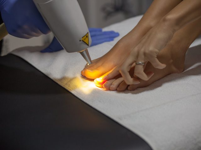 Как проходит лечение лазером вросшего ногтя
