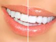 Как сделать зубы белее, белыми
