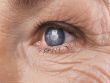 Катаракта глаза: методы лечения