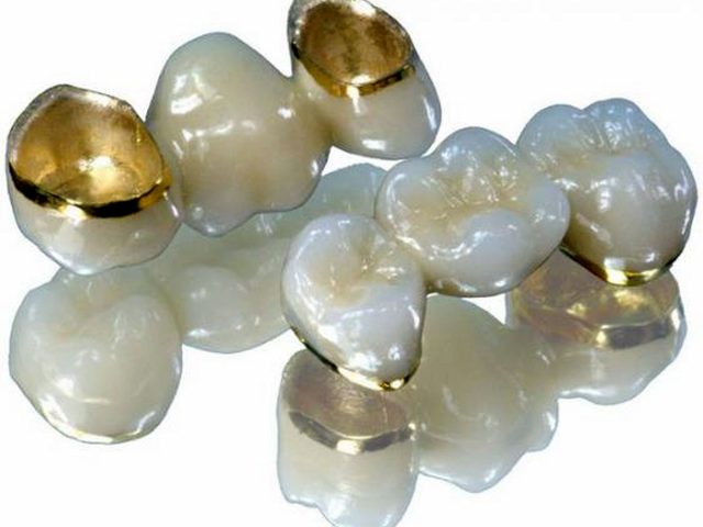 Протезирование зубов металлокерамикой: плюсы и минусы