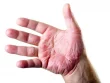 Что делать, если лопается кожа на пальцах рук