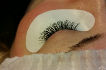 Катаракта глаза: лечение лазером