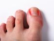 Вросший ноготь на ноге: первые симптомы