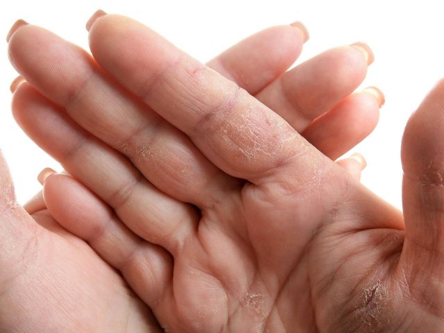 Что делать, если сохнет кожа на пальцах рук