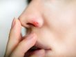 Герпес на носу: быстрое лечение